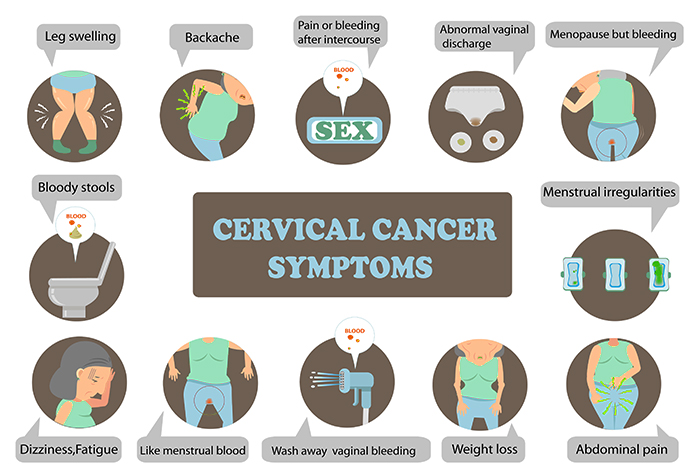 Stages Of Cervical Cancer Chart 6246