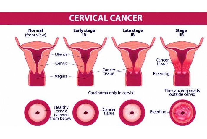 Stages of Cervical Cancer
