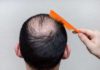 Alopecia