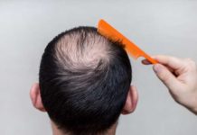 Alopecia and its Most Common Drug List Alopecia