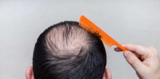 Alopecia