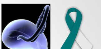 Cervical Cancer