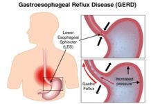 Gastroesophageal Reflux Disease (GERD) and Its Most Common Drug List Gastroesophageal Reflux Disease (GERD) and Its Most Common Drug List