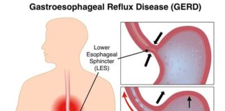 Gastroesophageal Reflux Disease (GERD) and Its Most Common Drug List