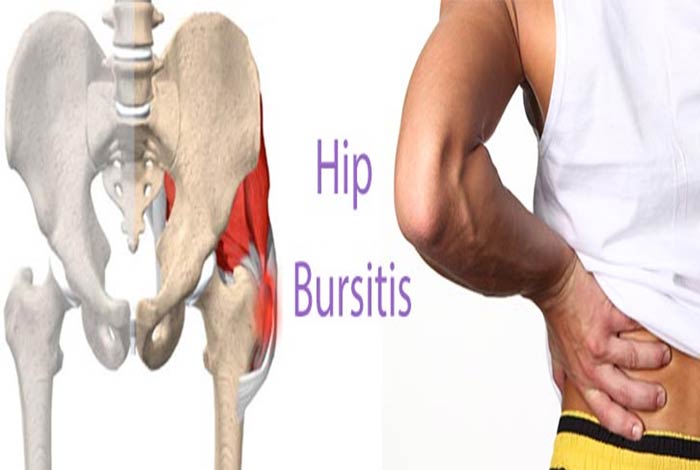 Hip Bursitis