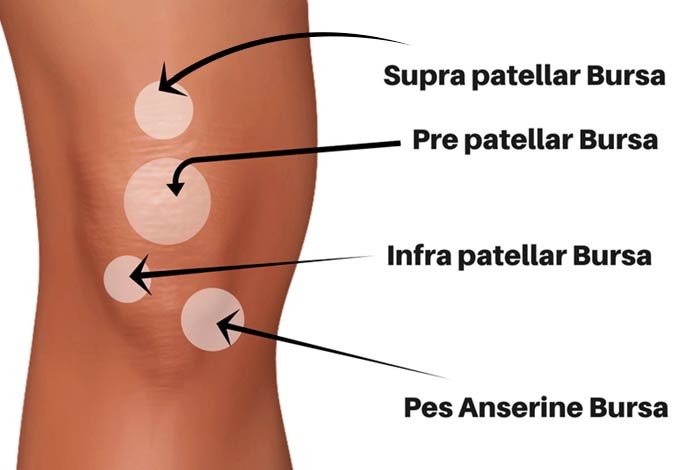 Knee Bursitis