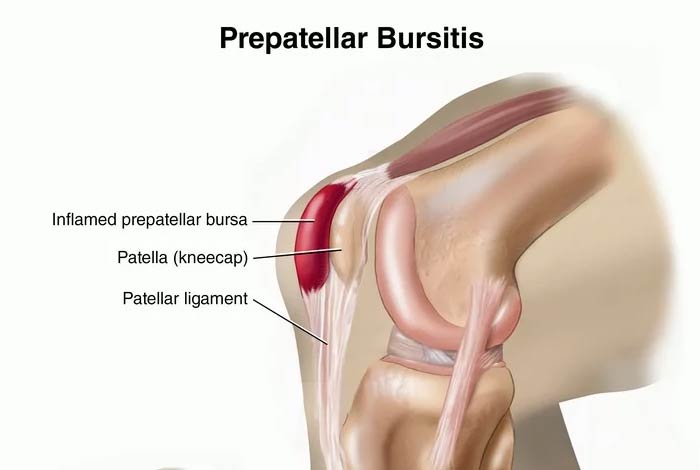 Kneecap Bursitis