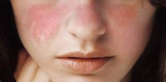 Lupus and it's Most Common Drug List
