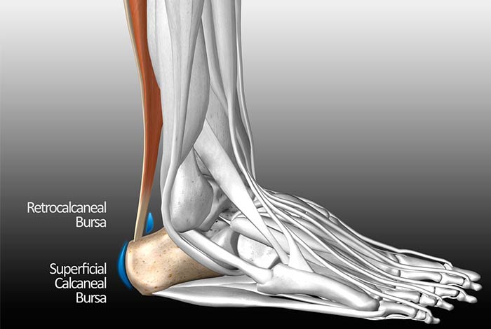 Posterior Achilles Tendon Bursitis