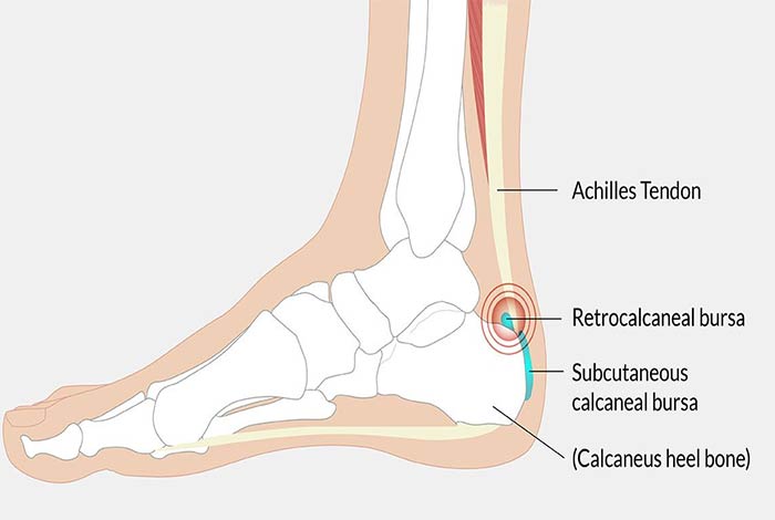 Types and Symptoms of Bursitis