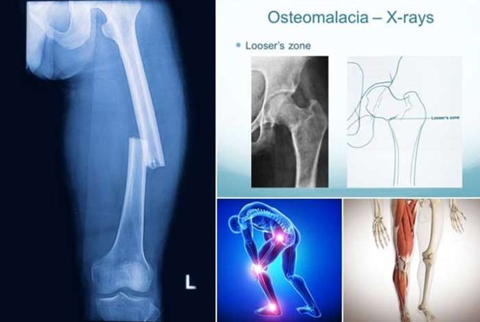 bone fractures