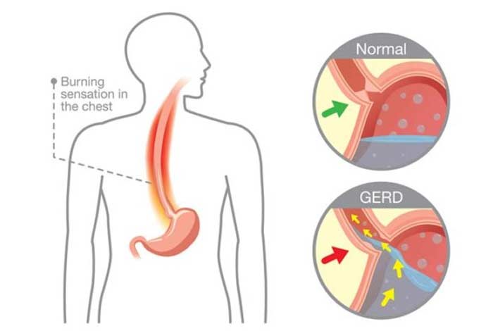 causes of gerd