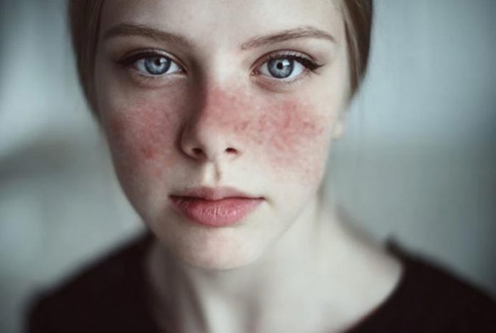 lupus types symptoms causes prevention and treatment