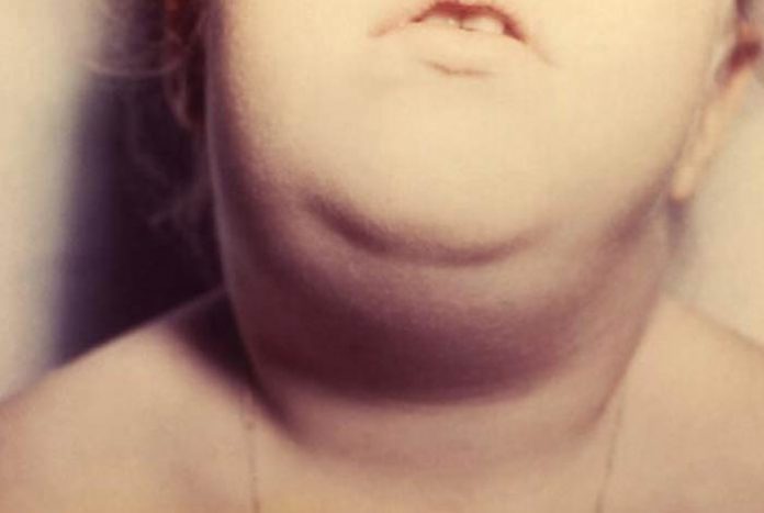 mumps and its most common drug list