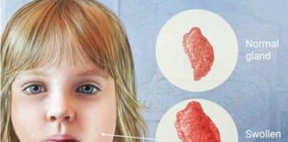 Mumps – Types, Symptoms, Diagnosis, Prevention and Treatment mumps types symptoms diagnosis prevention and treatment