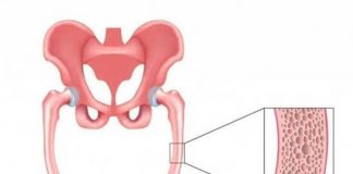 Osteomalacia – Causes, Symptoms, Prevention and Treatment osteomalacia causes symptoms prevention and treatment