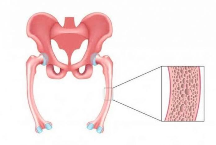 osteomalacia causes symptoms prevention and treatment