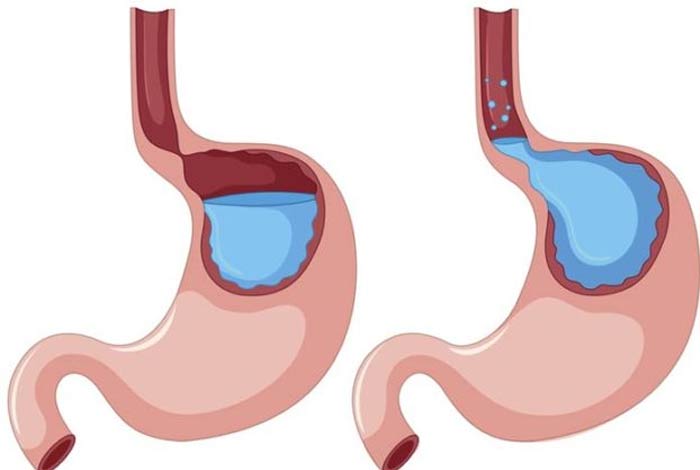 types of gerd