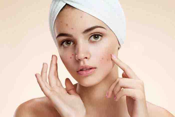 What and What Not to Eat If You Have Acne-Prone Skin