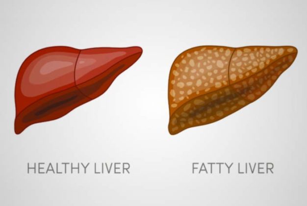 the-link-between-liver-and-cholesterol-explained