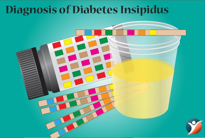 diagnosis of diabetes insipidus 