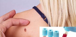melanoma