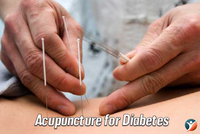 Acupuncture for Diabetes