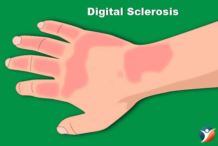 Digital Sclerosis