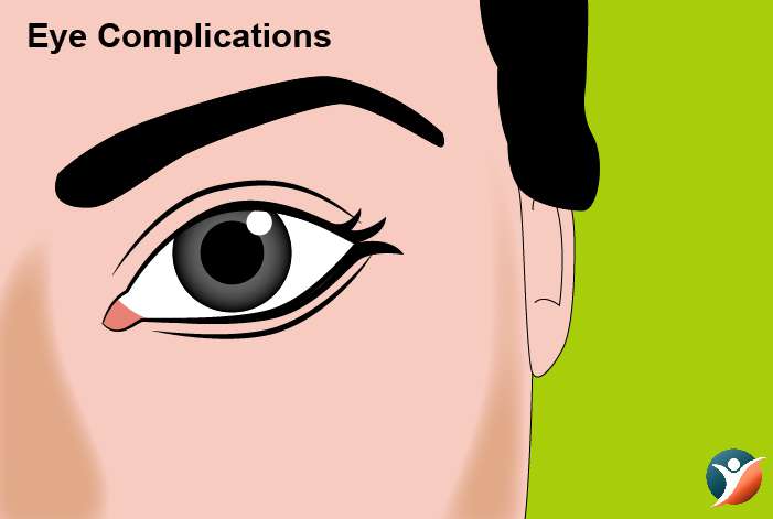 Eye Complications