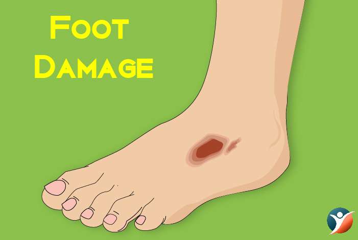 Foot Damage