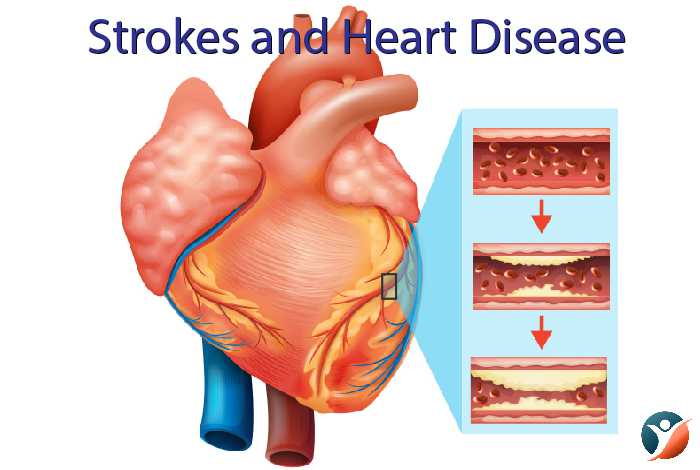 strokes and heart problems in diabetes