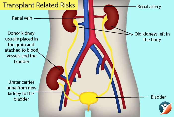 Risks and Complications Associated with Kidney Transplant