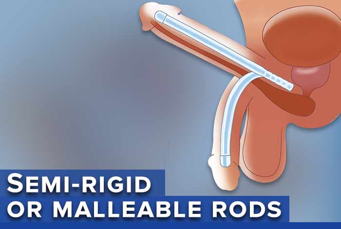 semi rigid or malleable rods