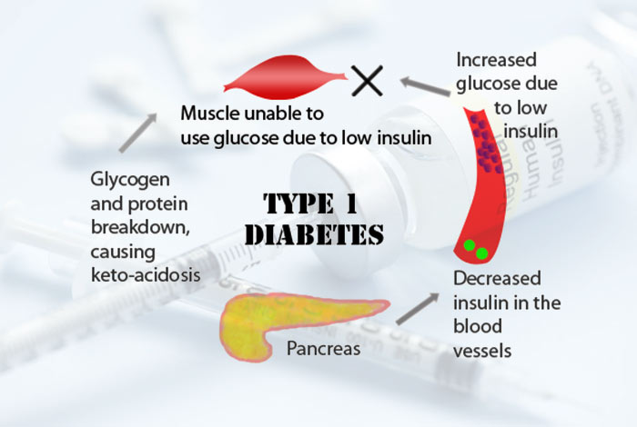 Etiological Classification of Diabetes Mellitus