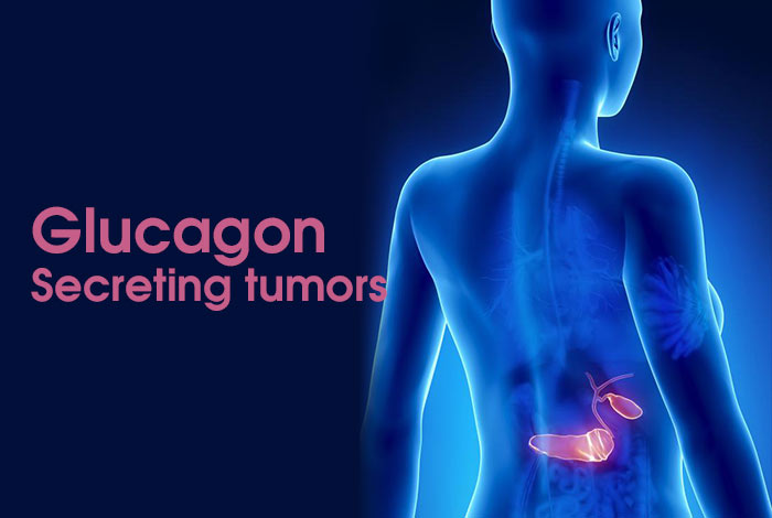 Glucagon- secreting tumors (Glucagonoma)