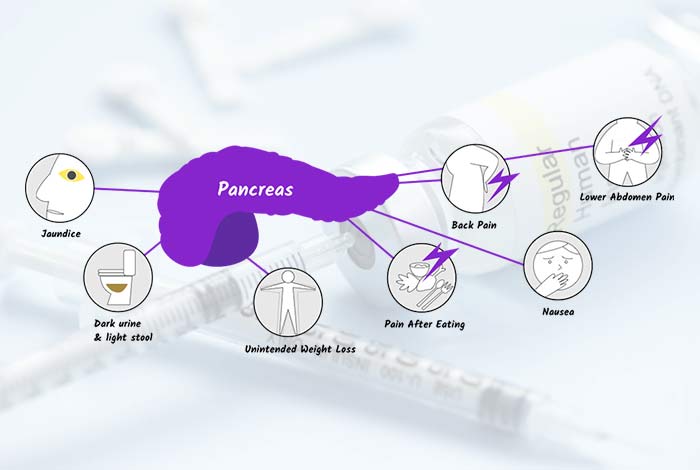 Somatostatin- secreting tumors (Somatostatinomas)