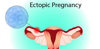 Ectopic Pregnancy