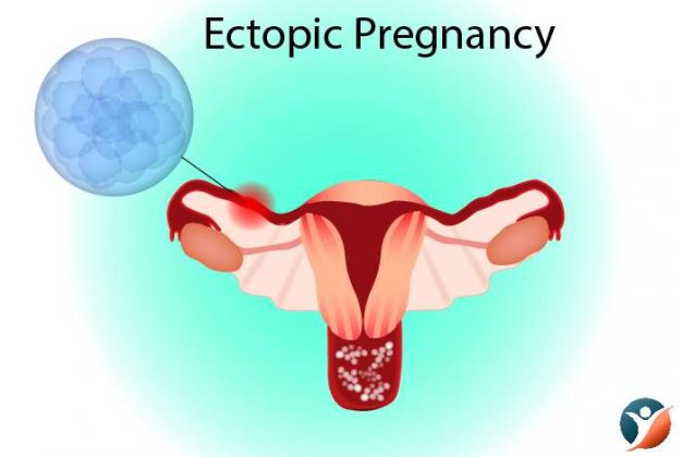 Ectopic Pregnancy Symptoms Causes Diagnosis And Treatment 