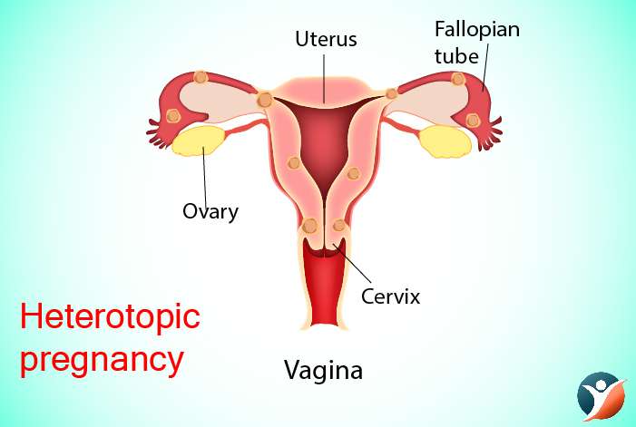 Heterotopic pregnancy