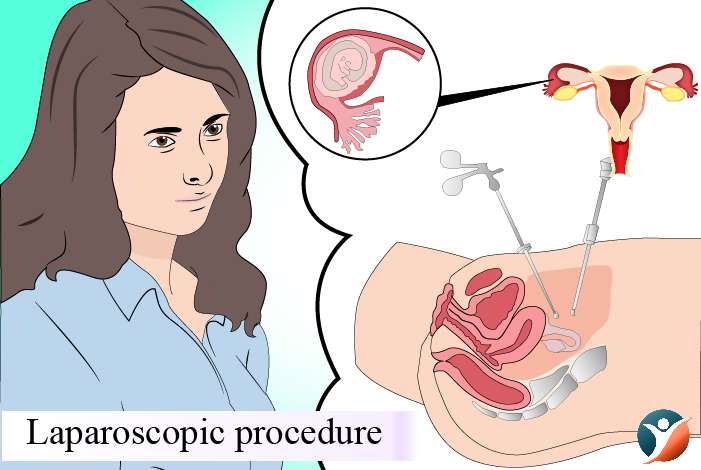 Laparoscopic procedure