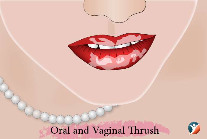 Oral and Vaginal Thrush