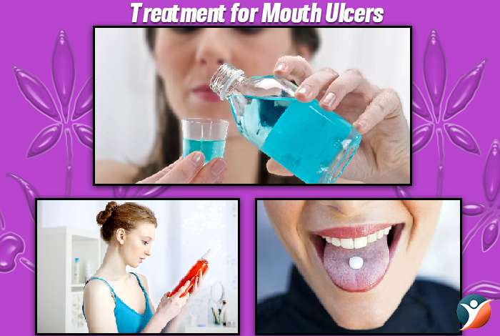 Treatment for Mouth Ulcers 