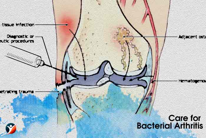 Care for Bacterial Arthritis