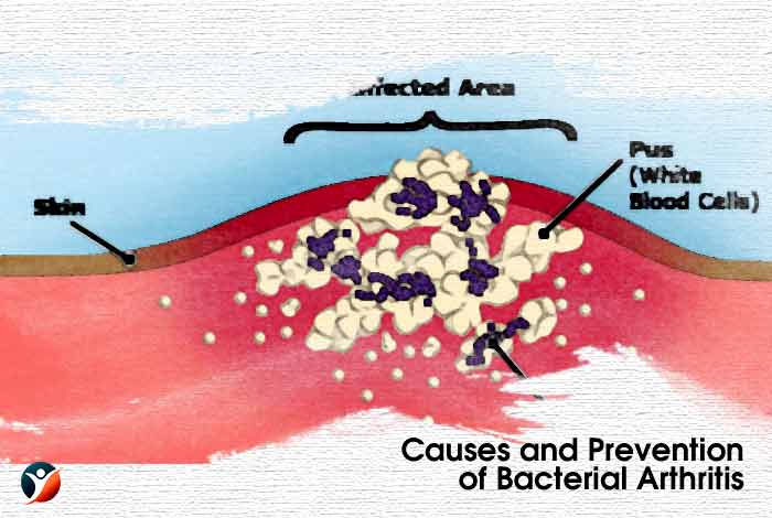 Causes and Prevention of Bacterial Arthritis