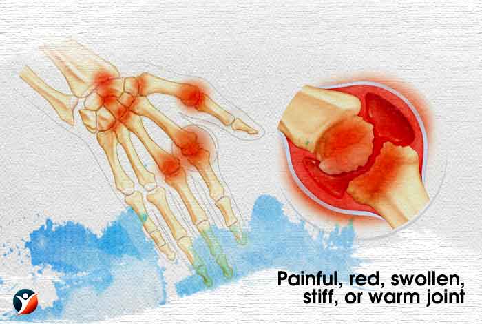 Painful red swollen stiff or warm joint
