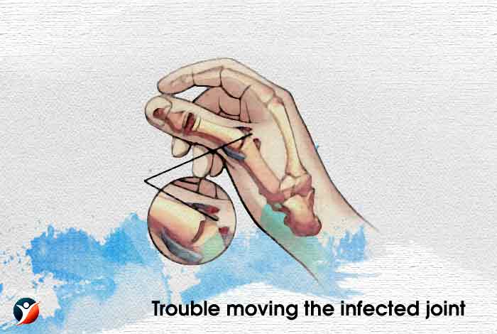 Trouble moving the infected joint