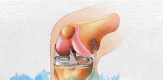 Bacterial Arthritis