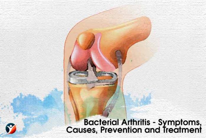 Bacterial Arthritis