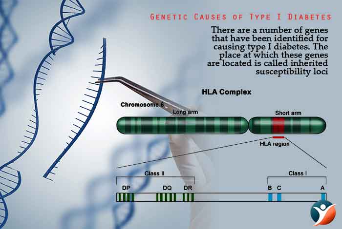 Genetic Causes of Type I Diabetes