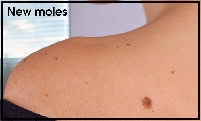 New moles